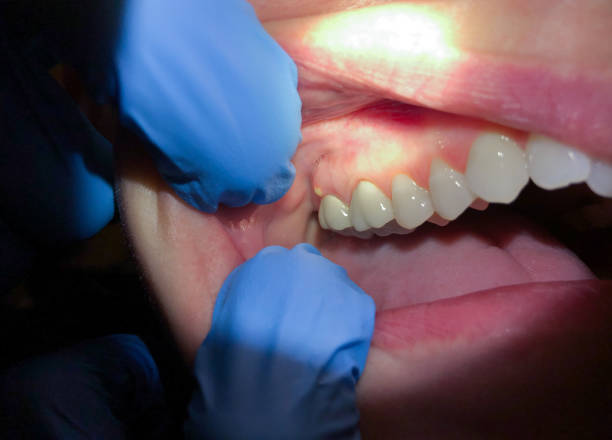 Best Emergency Tooth Extraction in North Liberty, IN